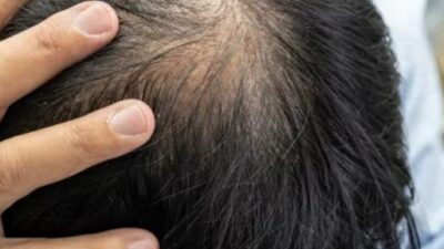 TIPS MENGATASI RAMBUT RONTOK